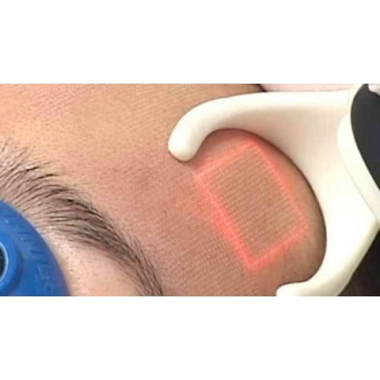 Fractional laser for scars